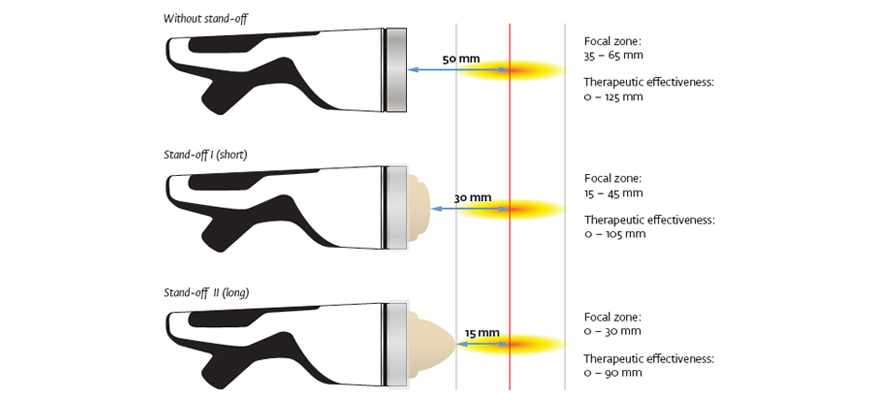 Focus Shockwave for Plantar Fasciitis